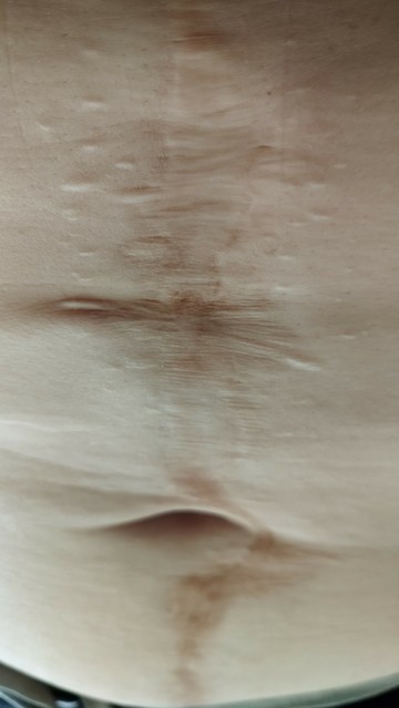 Horizontale Narbe von unter der Brust bis zum Schambein mit ruinierter Bauchnabeöffnung, an der oberen Bauchnarbe sind die Tackernarben sichtbar 
